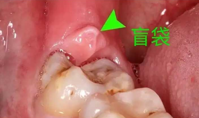 07 盲袋是什么，有啥危害？.png